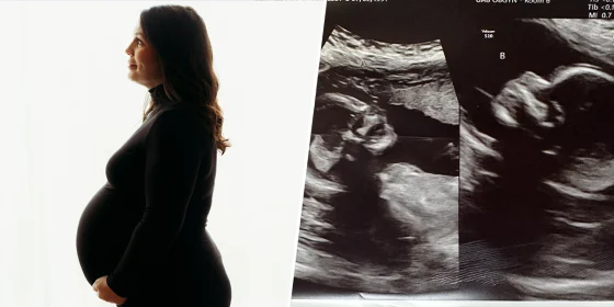 Kelsey Hatcher, 32, was born with two uteruses and is now carrying two pregnancies
